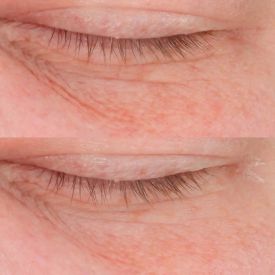 Cold Plasma Plus+ Advanced Eye Cream by Perricone MD 0.5 oz for Unisex